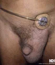 INGUINAL HERNIA - HERNIA TRUSS