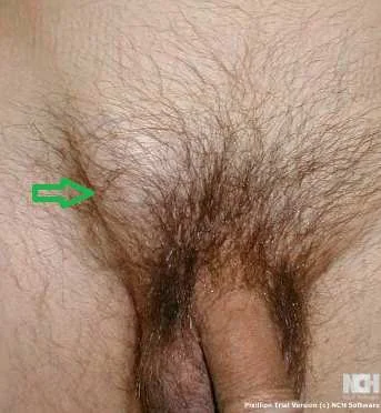 INGUINAL HERNIA