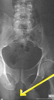 INGUINAL HERNIA - AIR IN THE SOFT TISSUES