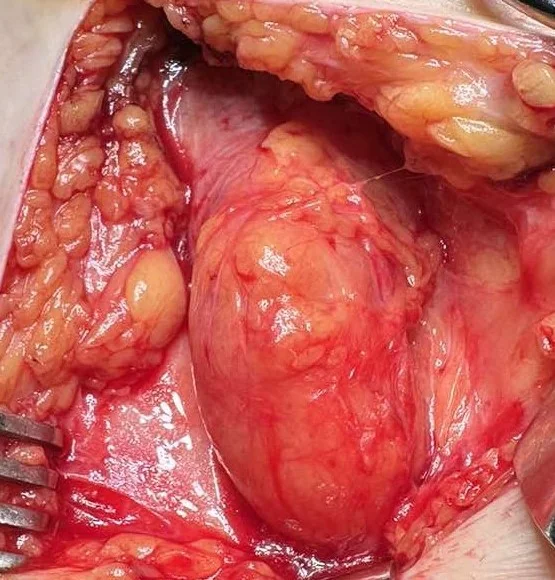 INGUINAL HERNIA REPAIR