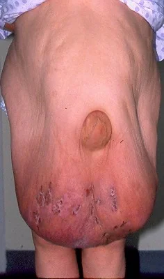 ABDOMINAL HERNIA - ABDOMINAL APRON