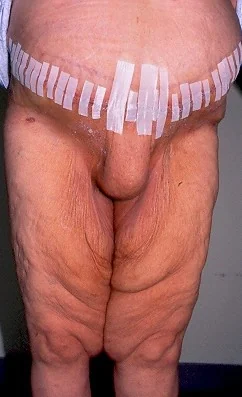 ABDOMINAL HERNIA REPAIR - ABDOMINOPLASTY