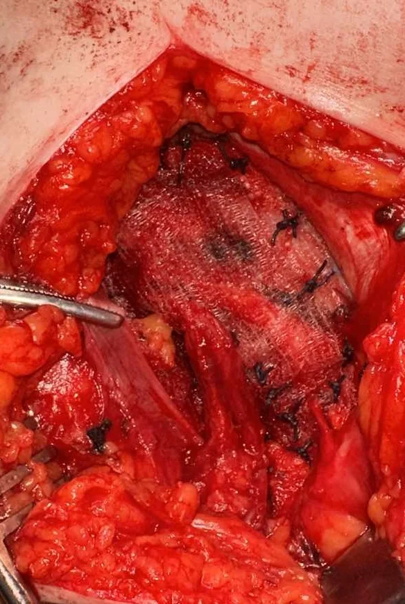 NO TENSION INGUINAL HERNIA REPAIR