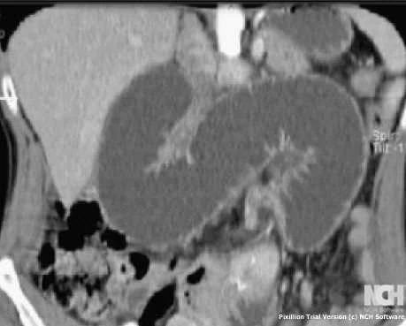 PETERSEN SPACE HERNIA