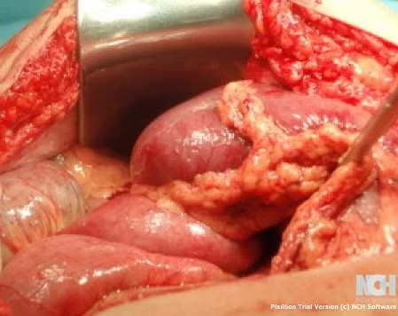 PETERSEN SPACE HERNIA