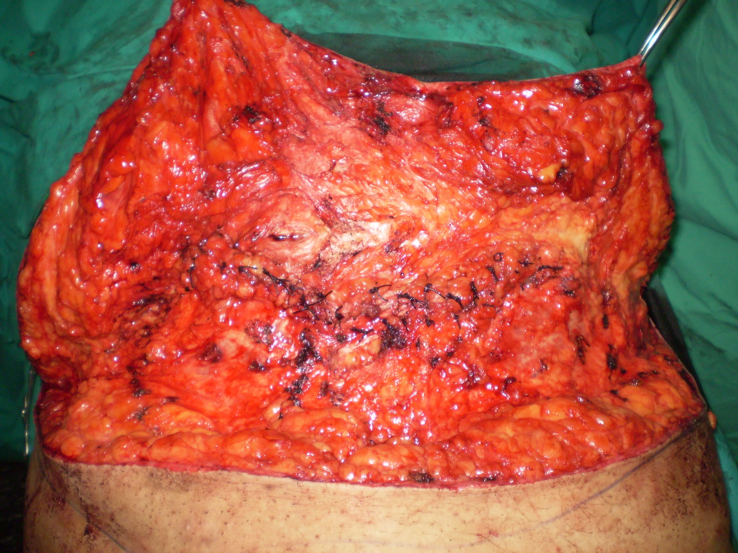 HERNIAL DEFECT CLOSURE
