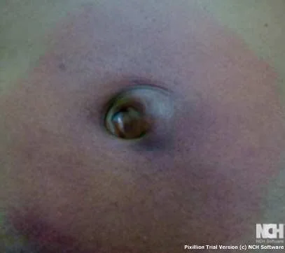 STRANGULATED RICHTER'S HERNIA 