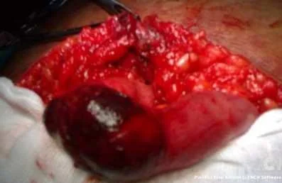 STRANGULATED RICHTER'S HERNIA