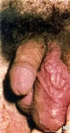 VARICOCELE