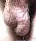 VARICOCELE