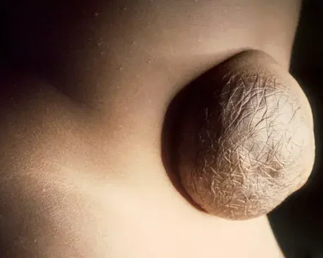 UMBILICAL HERNIA