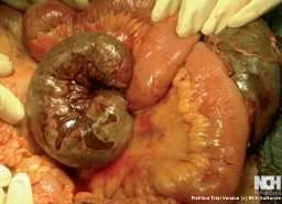 TRANSMESENTERIC HERNIA 