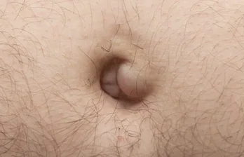 UMBILICAL HERNIA