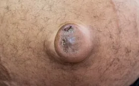 UMBILICAL HERNIA