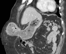 UMBILICAL HERNIA