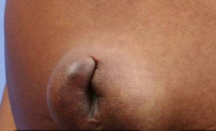 UMBILICAL HERNIA 