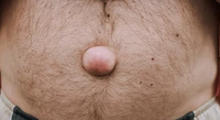 UMBILICAL HERNIA 