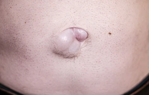 UMBILICAL HERNIA 