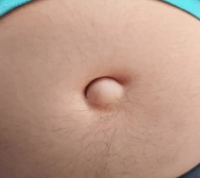 UMBILICAL HERNIA 