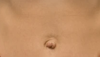 UMBILICAL HERNIA 