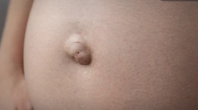 UMBILICAL HERNIA 