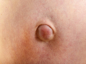 UMBILICAL HERNIA 