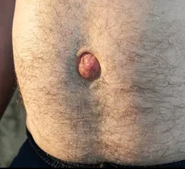 UMBILICAL HERNIA 