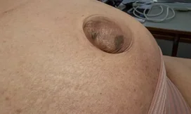 UMBILICAL HERNIA 
