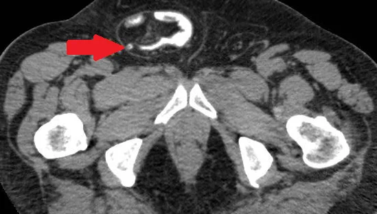 AMYAND'S HERNIA