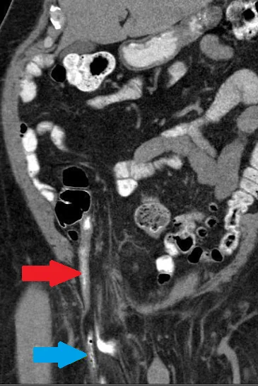 AMYAND'S HERNIA