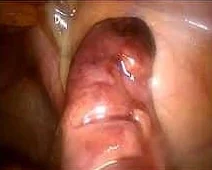AMYAND'S HERNIA