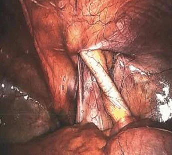 AMYAND'S HERNIA
