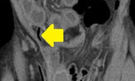 AMYAND'S HERNIA