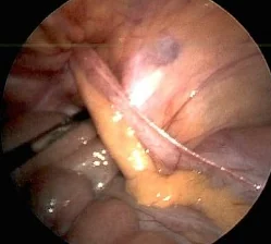 DE GARENGEOT'S HERNIA