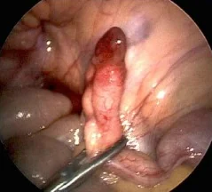 REDUCED DE GARENGEOT'S HERNIA