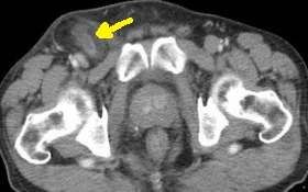 DE GARENGEOT'S HERNIA