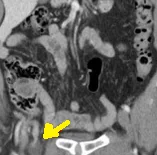 DE GARENGEOT'S HERNIA