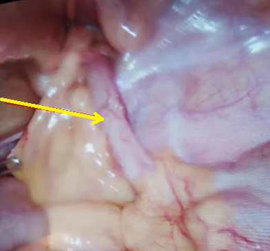 DE GARENGEOT'S HERNIA