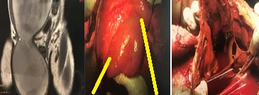 AMYAND'S HERNIA