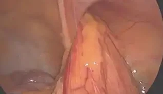 INCARCERATED AMYAND'S HERNIA