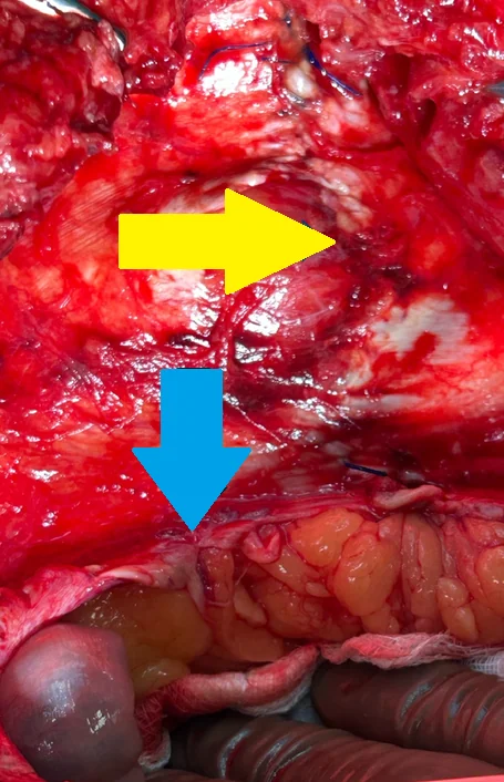INTERPARIETAL HERNIA