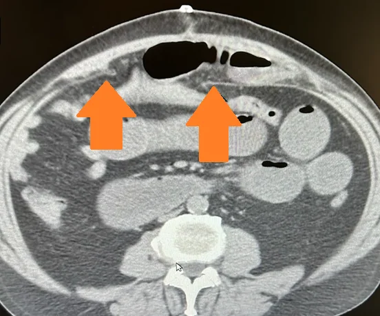 INTERPARIETAL HERNIA