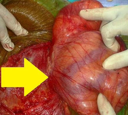INTERPARIETAL HERNIA