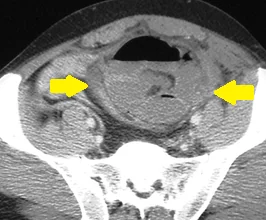 INTERPARIETAL HERNIA