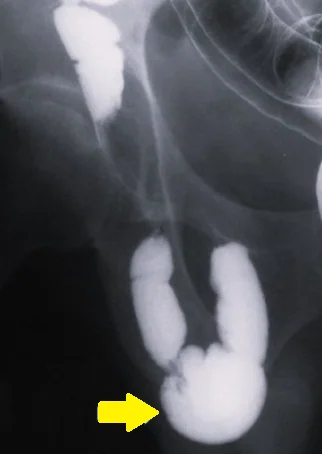 LITTRE'S HERNIA