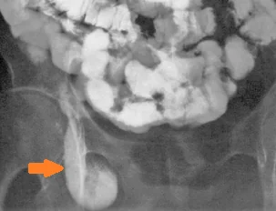 LITTRE'S HERNIA
