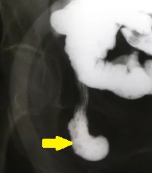 LITTRE'S HERNIA