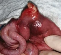 LITTRE'S HERNIA