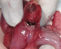 LITTRE'S HERNIA