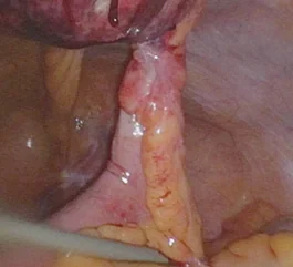 LITTRE'S HERNIA